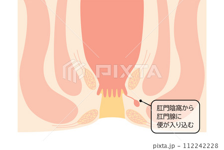 肛門の病気、痔「あな痔（痔ろう）」　図解イラスト、断面図 112242228