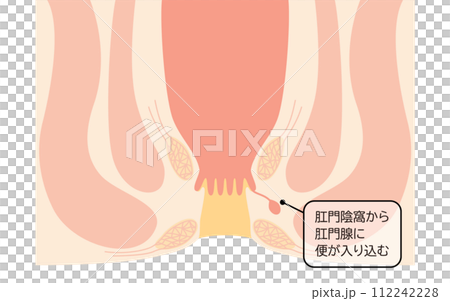 肛門の病気、痔「あな痔（痔ろう）」　図解イラスト、断面図 112242228