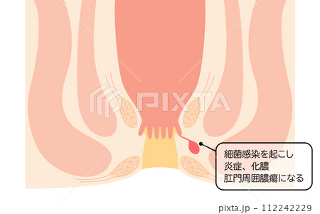 肛門の病気、痔「あな痔（痔ろう）」　図解イラスト、断面図 112242229