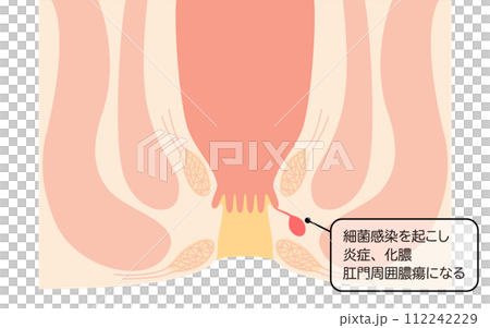 肛門の病気、痔「あな痔（痔ろう）」　図解イラスト、断面図 112242229