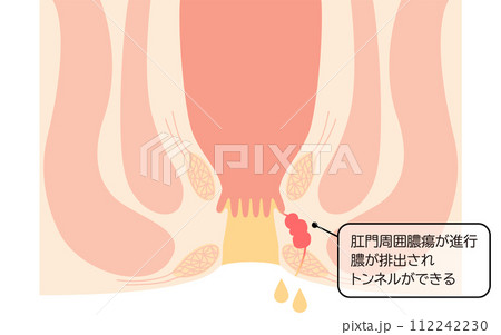 肛門の病気、痔「あな痔（痔ろう）」　図解イラスト、断面図 112242230