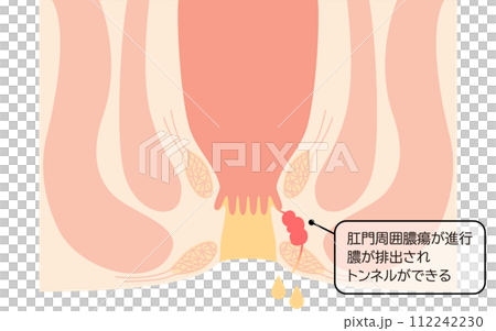 肛門の病気、痔「あな痔（痔ろう）」　図解イラスト、断面図 112242230