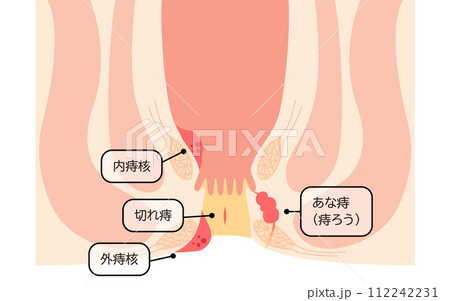 肛門の病気、痔・いぼ痔・切れ痔・あな痔　図解イラスト、断面図 112242231