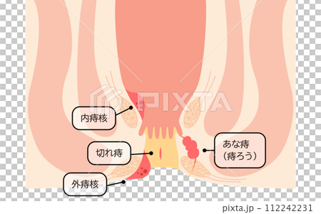 肛門の病気、痔・いぼ痔・切れ痔・あな痔　図解イラスト、断面図 112242231