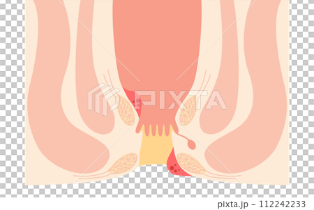 肛門疾病、痔瘡/疣痔插圖、橫切面圖 112242233