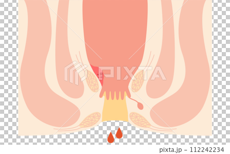 肛門疾病、痔瘡/疣痔「I 級內痔」插圖，橫斷面圖 112242234