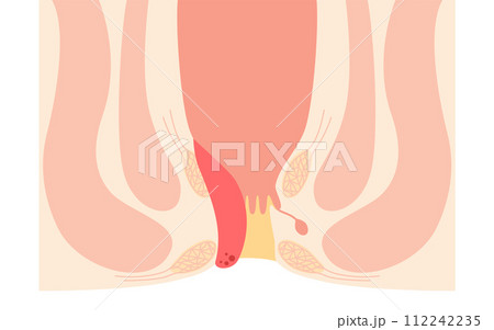 肛門の病気、痔・いぼ痔「内痔核Ⅱ度」　図解イラスト、断面図 112242235
