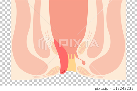 肛門の病気、痔・いぼ痔「内痔核Ⅱ度」　図解イラスト、断面図 112242235