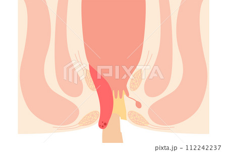 肛門の病気、痔・いぼ痔「内痔核Ⅳ度」 図解イラスト、断面図 肛門の病気、痔・いぼ痔「内痔核Ⅳ度」 図解イラスト、断面図 112242237
