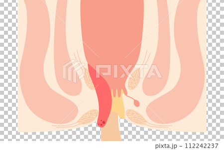 肛門の病気、痔・いぼ痔「内痔核Ⅳ度」 図解イラスト、断面図 肛門の病気、痔・いぼ痔「内痔核Ⅳ度」 図解イラスト、断面図 112242237