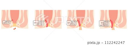 肛門の病気、痔・いぼ痔「内痔核Ⅰ～Ⅳ度」　図解イラスト、断面図 112242247