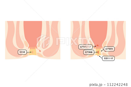 肛門の病気、痔「切れ痔、肛門潰瘍、肛門狭窄、肛門ポリープ」 図解イラスト、断面図 肛門の病気、痔「切れ痔、肛門潰瘍、肛門狭窄、肛門ポリープ」 図解イラスト、断面図 112242248