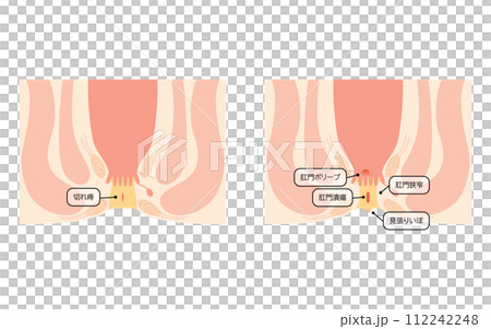 肛門の病気、痔「切れ痔、肛門潰瘍、肛門狭窄、肛門ポリープ」 図解イラスト、断面図 肛門の病気、痔「切れ痔、肛門潰瘍、肛門狭窄、肛門ポリープ」 図解イラスト、断面図 112242248