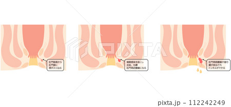 肛門の病気、痔「あな痔（痔ろう）」　図解イラスト、断面図 112242249