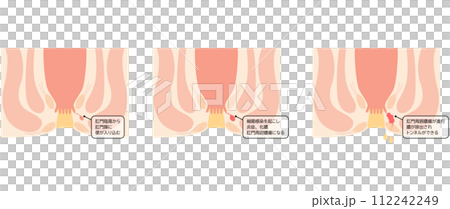 肛門の病気、痔「あな痔（痔ろう）」　図解イラスト、断面図 112242249