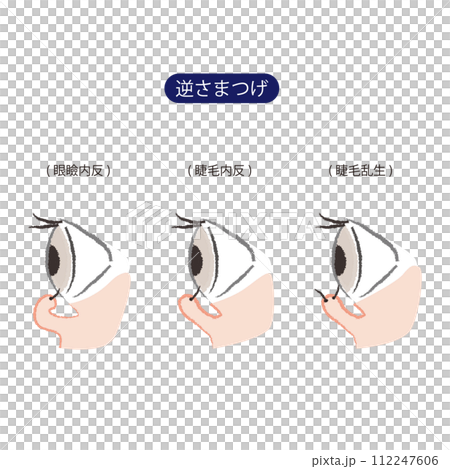 倒睫毛的3種類型(眼瞼內翻、睫毛內翻、睫毛內翻) 倒睫毛的3種類型(眼瞼內翻、睫毛內翻、睫毛內翻) 112247606
