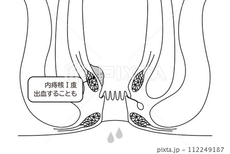 肛門の病気、痔・いぼ痔「内痔核Ⅰ度」　図解イラスト、断面図 112249187