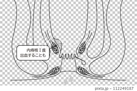 Anal disease, hemorrhoids/wart hemorrhoids "internal hemorrhoids grade I" Illustrated illustration, cross-sectional view 112249187