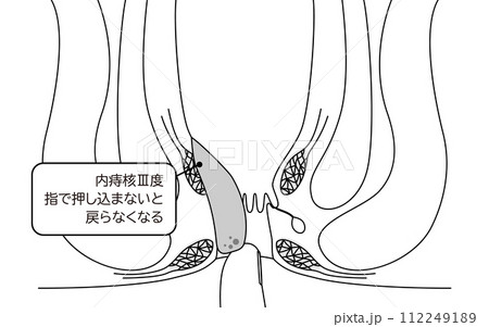 肛門の病気、痔・いぼ痔「内痔核Ⅲ度」 図解イラスト、断面図 肛門の病気、痔・いぼ痔「内痔核Ⅲ度」 図解イラスト、断面図 112249189