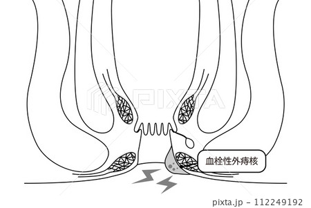 肛門の病気、痔・いぼ痔「血栓性外痔核」 図解イラスト、断面図 肛門の病気、痔・いぼ痔「血栓性外痔核」 図解イラスト、断面図 112249192