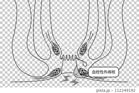 肛門の病気、痔・いぼ痔「血栓性外痔核」 図解イラスト、断面図 肛門の病気、痔・いぼ痔「血栓性外痔核」 図解イラスト、断面図 112249192