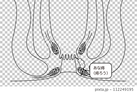 肛門疾病，痔瘡「肛門痔瘡」插圖，橫斷面圖 112249195