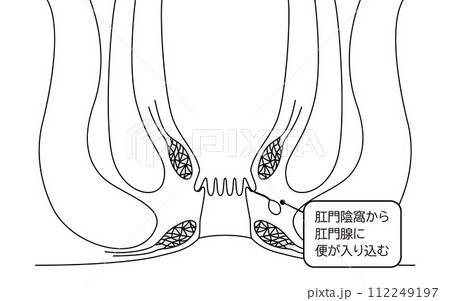肛門の病気、痔「あな痔（痔ろう）」　図解イラスト、断面図 112249197