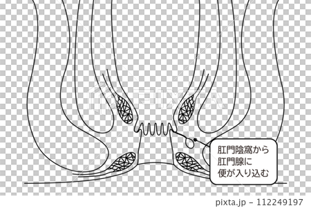 肛門の病気、痔「あな痔（痔ろう）」　図解イラスト、断面図 112249197