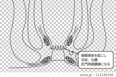 Anal disease, hemorrhoids "Anal hemorrhoids" Illustrated illustration, cross-sectional view 112249198