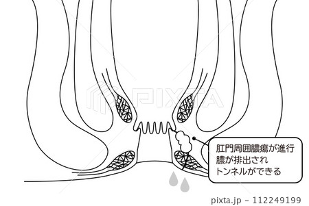 肛門の病気、痔「あな痔（痔ろう）」　図解イラスト、断面図 112249199