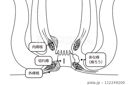 肛門の病気、痔・いぼ痔・切れ痔・あな痔 図解イラスト、断面図のイラスト素材 [112249200] - PIXTA