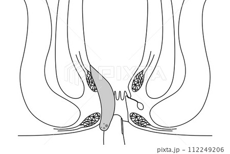 肛門の病気、痔・いぼ痔「内痔核Ⅳ度」　図解イラスト、断面図 112249206