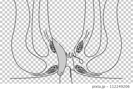 肛門の病気、痔・いぼ痔「内痔核Ⅳ度」　図解イラスト、断面図 112249206