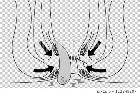 Anal disease, hemorrhoids/wart hemorrhoids "incarcerated hemorrhoids" Illustrated illustrations, cross-sectional views 112249207