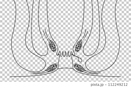 肛門の病気、痔「あな痔（痔ろう）」　図解イラスト、断面図 112249212