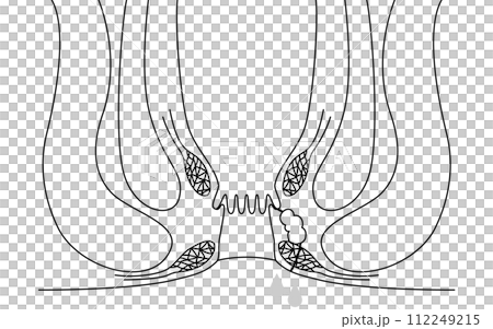 肛門疾病,痔瘡「肛門痔瘡」插圖,橫斷面圖 肛門疾病,痔瘡「肛門痔瘡」插圖,橫斷面圖 112249215