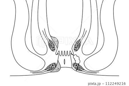 肛門の病気、痔・いぼ痔・切れ痔・あな痔　図解イラスト、断面図 112249216