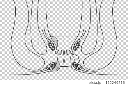 肛門の病気、痔・いぼ痔・切れ痔・あな痔　図解イラスト、断面図 112249216