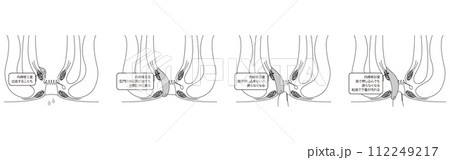 肛門の病気、痔・いぼ痔「内痔核Ⅰ~Ⅳ度」 図解イラスト、断面図 肛門の病気、痔・いぼ痔「内痔核Ⅰ~Ⅳ度」 図解イラスト、断面図 112249217