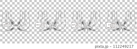 肛門の病気、痔・いぼ痔「内痔核Ⅰ~Ⅳ度」 図解イラスト、断面図 肛門の病気、痔・いぼ痔「内痔核Ⅰ~Ⅳ度」 図解イラスト、断面図 112249217