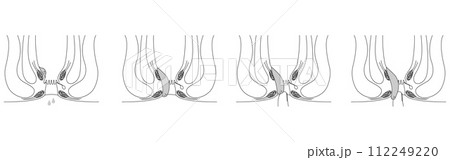 肛門の病気、痔・いぼ痔「内痔核Ⅰ～Ⅳ度」　図解イラスト、断面図 112249220