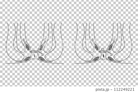 肛門の病気、痔「切れ痔、肛門潰瘍、肛門狭窄、肛門ポリープ」 図解イラスト、断面図 肛門の病気、痔「切れ痔、肛門潰瘍、肛門狭窄、肛門ポリープ」 図解イラスト、断面図 112249221