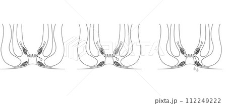 肛門の病気、痔「あな痔（痔ろう）」　図解イラスト、断面図 112249222