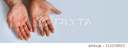 Human Hands with Painful Rash, Red Spots Blisters on the Skin. Health Problem. Monkeypox Disease Symptoms. Male Patient Arms with Monkey Pox. Close Up. Banner, Copy Space. Dengue Fever Infection, MPOX 112258023