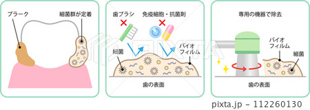 歯のバイオフィルム除去 112260130