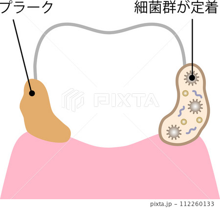 歯のバイオフィルム 112260133