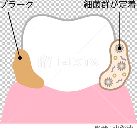 歯のバイオフィルム 112260133