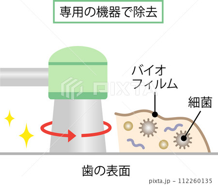 歯のバイオフィルム除去 112260135
