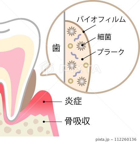 歯のバイオフィルム 歯のバイオフィルム 112260136