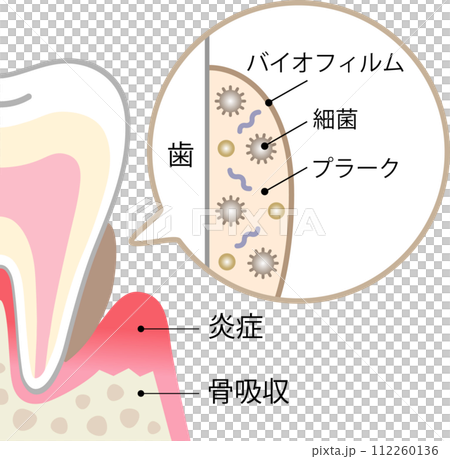 歯のバイオフィルム 歯のバイオフィルム 112260136